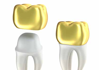 Indianapolis explains procedure for dental crowns