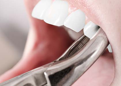 When a dental extraction might be necessary: Dr. Matthew Church explains.