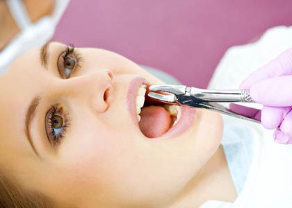 Dental tooth extracting from Dentist in indianapolis