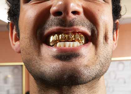 reason to consider a gold tooth crown for restorative care
