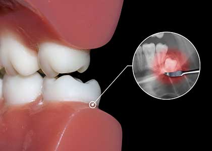 Dr. Matthew Church explains the reasons for root canals and tooth extractions.