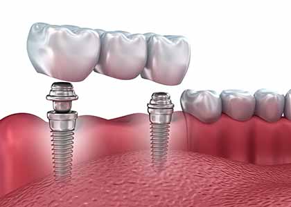 What are the most common reasons for choosing crowns and bridges