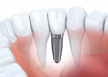 Indianapolis provides dental implants