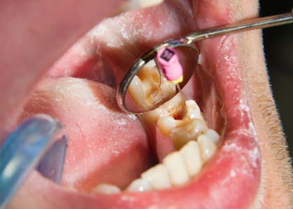Washington Street Dentistry Describe advanced gum disease can cause serious damage