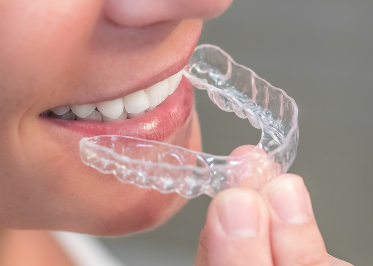 Fix Overbite with Invisalign in Indianapolis IN Area