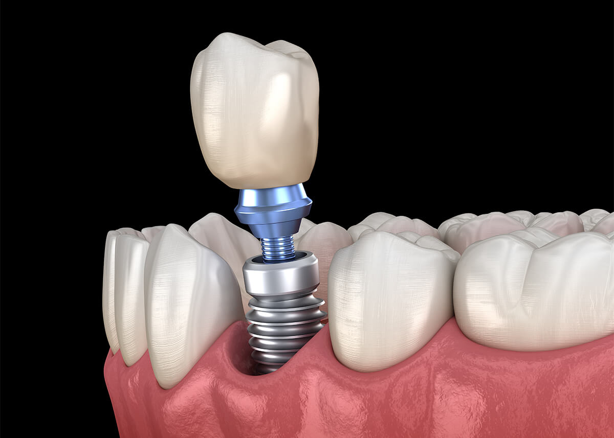 Dental Implant Surgery in Indianapolis Area